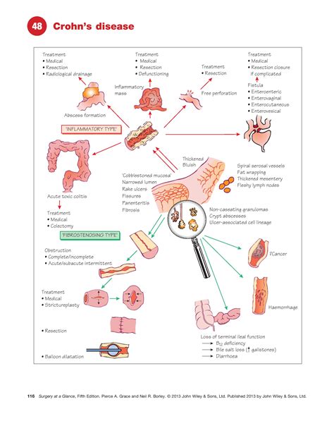 Crohn's Disease - Symptoms, Causes, Treatment & Prognosis