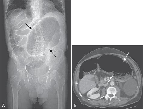 Miscellaneous Abnormalities of the Colon - Clinical Tree