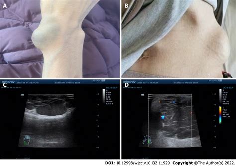 Blue rubber bleb nevus syndrome complicated with disseminated ...