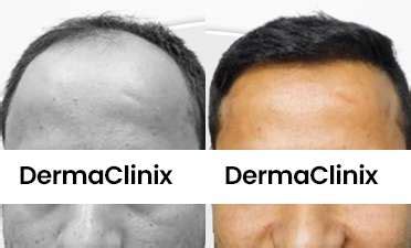 Best Hair Transplant Clinic in Delhi NCR | Skin Clinic in South Delhi