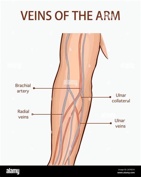 Vena Dolorosa En El Brazo