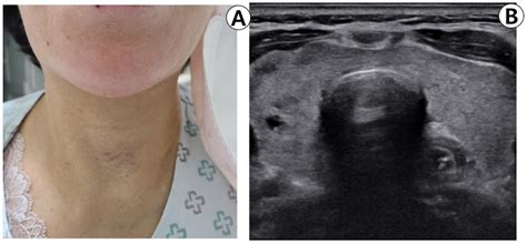 A Case of Diffuse Thyroid Hematoma after Ultrasound-Guided Fine Needle Aspiration