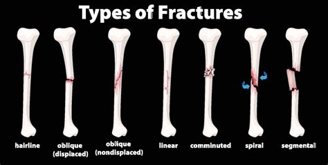 Is A Stress Fracture A Broken Bone | Detroit Chinatown