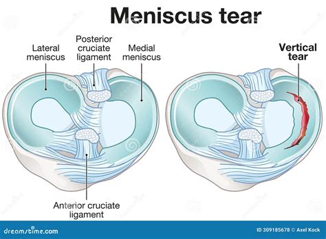 Meniscus Education | Education Center