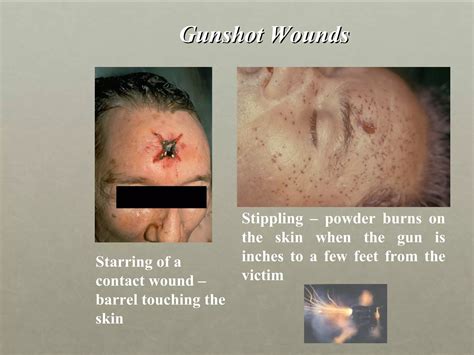 Wounds in forensic medicine | PPT