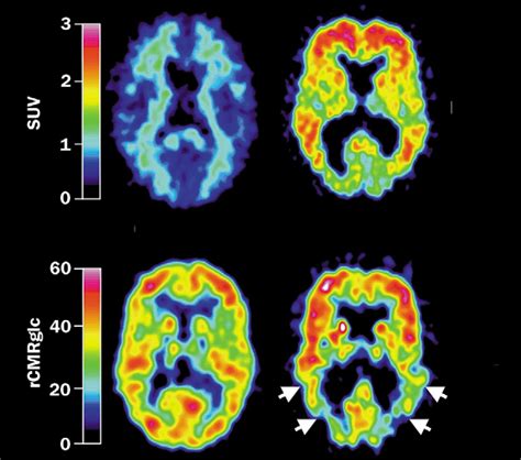 PET imaging of amyloid in Alzheimer's disease - The Lancet Neurology