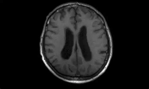 Rare case of Miller Fisher syndrome: a report