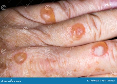 Blisters from Cryotherapy Treatment for Solar Keratosis Stock Photo - Image of lifted, painful ...