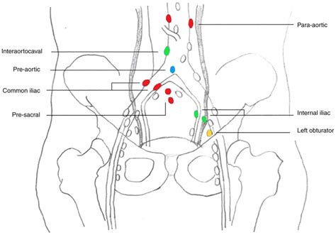 Para Aortic Lymph Nodes