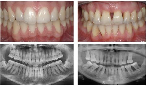 Periodontal Disease Before And After Pictures