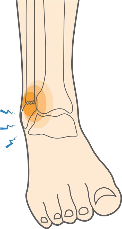 Ankle fractures