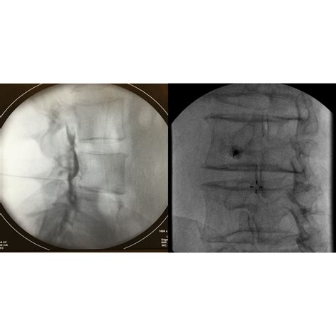 Effectiveness of Epidural Methylprednisolone Injection in Management of Lumbar Prolapsed ...