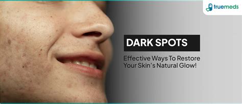 How to Remove Dark Spots on Face Naturally: Effective Home Remedies