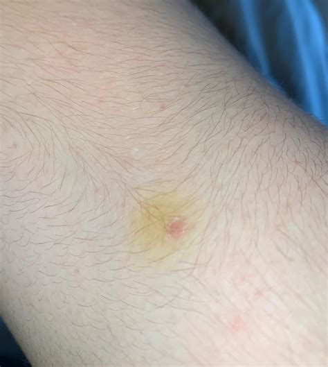 Yellow spot on arm, not a bruise. One more seems to be developing : r/Dermatology