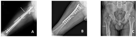 Subtrochanteric Insufficiency Fracture Occurring 5 Years after Surgery ...
