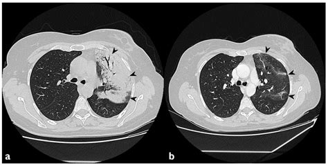 Organizing Pneumonia