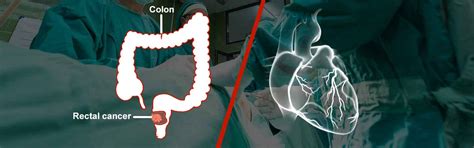 Rectal cancer - Diagnosis and treatment: Sequential cardiac and rectal ...