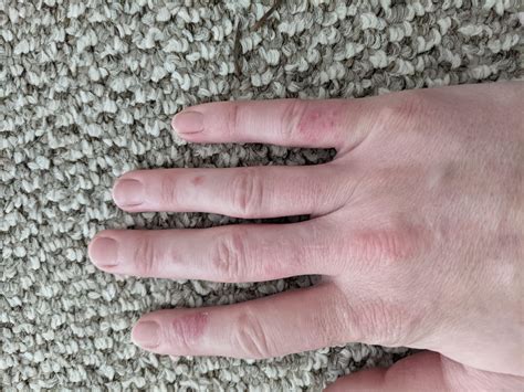 What is this rash on my fingers? It's killed off all the little finger ...