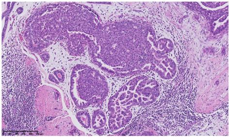 Cancers | Special Issue : Breast Development and Cancer