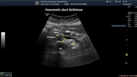 Gallstone inside the Pancreatic Duct [1 image] – EFSUMB