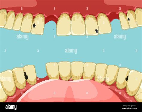 Human teeth inside mouth with yellow broken tooth illustration Stock ...