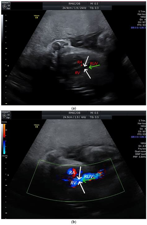 Persistent Right Umbilical Vein: Clinical Case and Literature Review