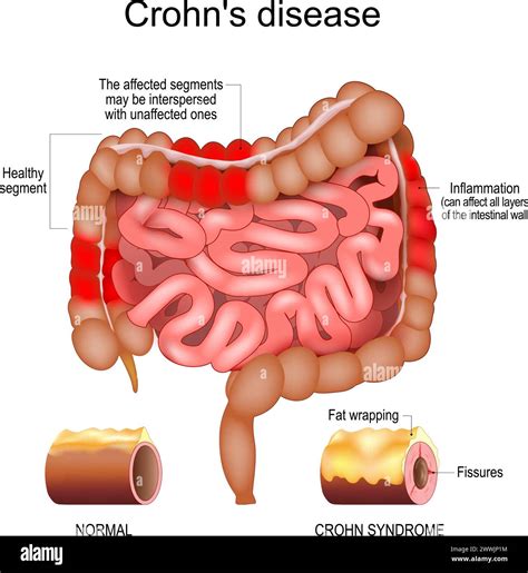 Crohn disease. Human large and small intestine with Healthy segments ...