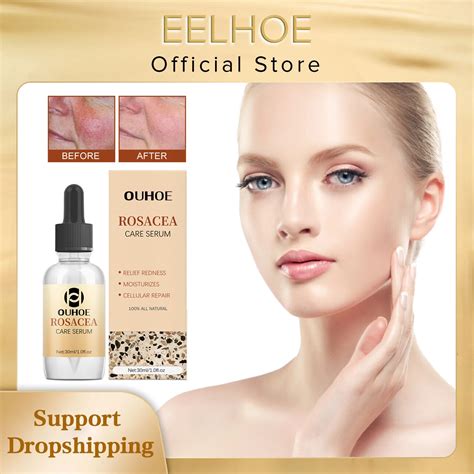 Rosacea Treatment Natural