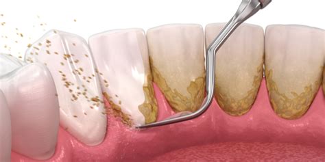 歯垢から歯石へ に対する画像結果