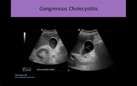 How To Read Ultrasound Of Abdomen at Holly Brough blog