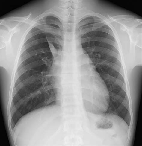 An enlarged azygos vein traversing an azygos lobe reveals a connection between the inferior vena ...