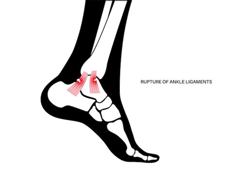 Травма растяжения связок лодыжки, искривление ног, боль и отек ...
