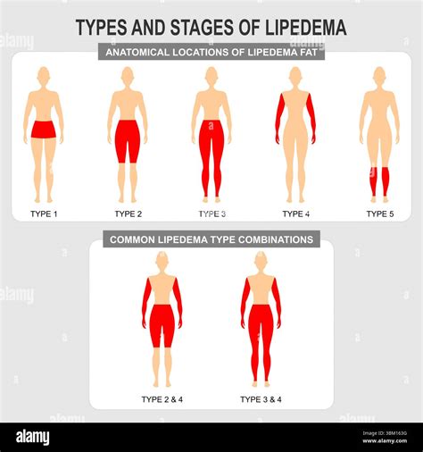Stages Of Lipedema