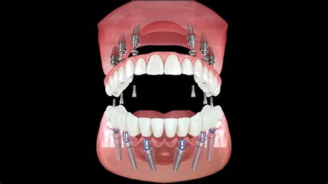 All-on-6 vs All-on-4 | Recovery Timeline & Immediate Loading Explained