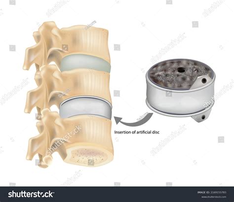 Herniated Disc Doctor: Over 51 Royalty-Free Licensable Stock Vectors & Vector Art | Shutterstock