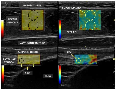 The Applicability of Shear Wave Elastography to Assess Myotendinous ...