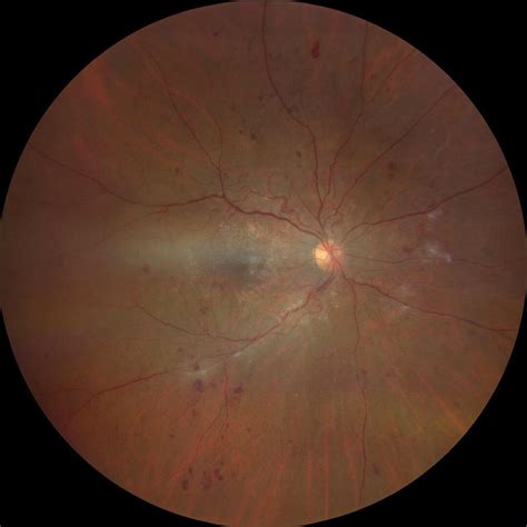 Diabetic Retinopathy Treatment in Rhode Island | Diabetic Eye Specialist