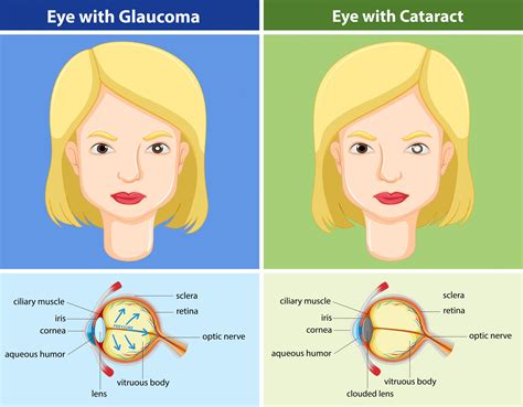 Cataract Symptoms Pain at Caitlin Grimmett blog