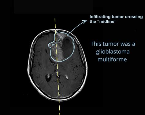 Glioblastoma Multiforme: the deadliest brain tumor - Pro doctor