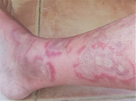 COVID‐19 and Mycoplasma pneumoniae: SARS‐CoV‐2 false positive or ...