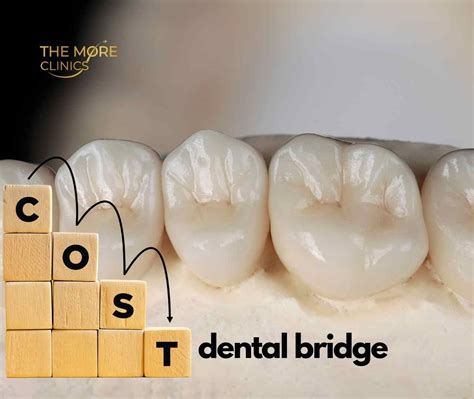 Types of Dental Bridge & Cost Comparison - The More Clinics Turkey