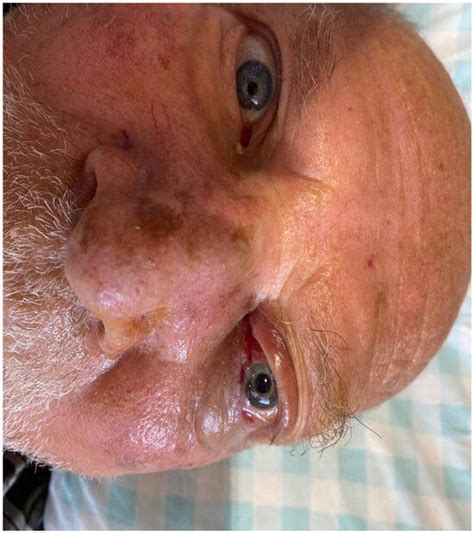 TropicalMed | Special Issue : Mucormycosis Unmasked: Advances in ...