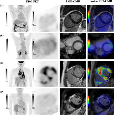 Diagnostic utility of fusion 18F-fluorodeoxyglucose positron emission tomography/cardiac ...