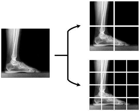 A Novel Deep Transfer Learning-Based Approach for Automated Pes Planus ...