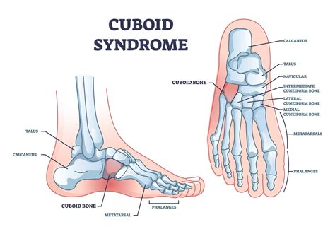 Cuboid Bone Pain