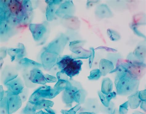 A case of Atypical Squamous Cells – Cannot exclude HSIL (ASC-H ...