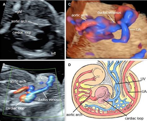 Twin reversed arterial perfusion sequence with a cardiac loop ...