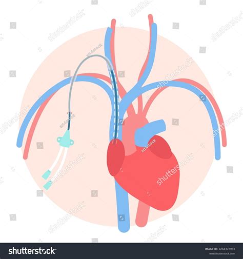 Tunneled Central Venous Catheter Placed Subclavian Stock Vector ...