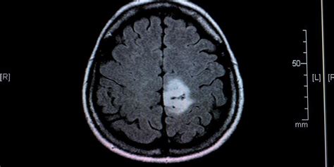 Brain tumor symptoms are explained by the Delhi cancer hospital