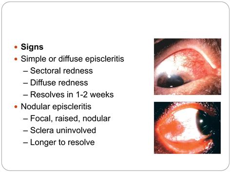 Episcleritis and Scleritis power point presentations | PPTX